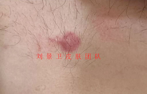 44疤痕.jpg