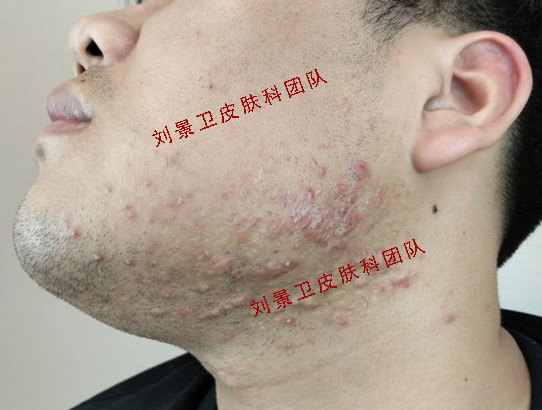 痤疮.jpg