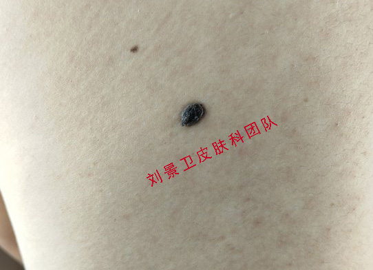 色素痣.jpg