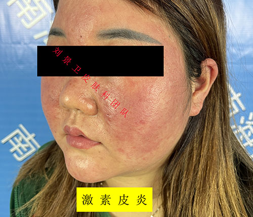 激素性皮炎.jpg