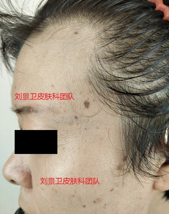 脂溢性角化病  老年斑.jpg