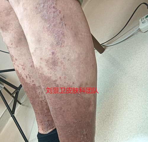 斑块银屑病 .jpg