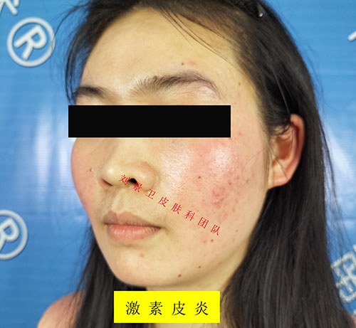 过敏性皮炎1.jpg