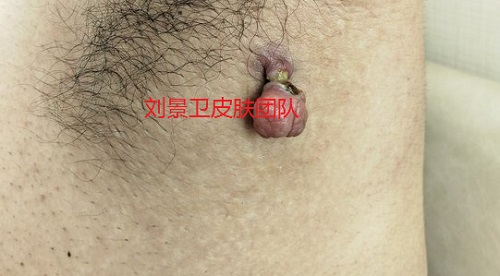 纤维瘤.jpg