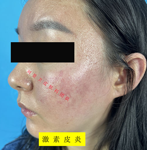 激素皮炎8.jpg