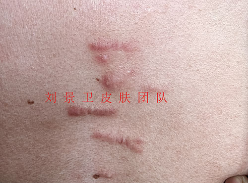 疤痕.jpg