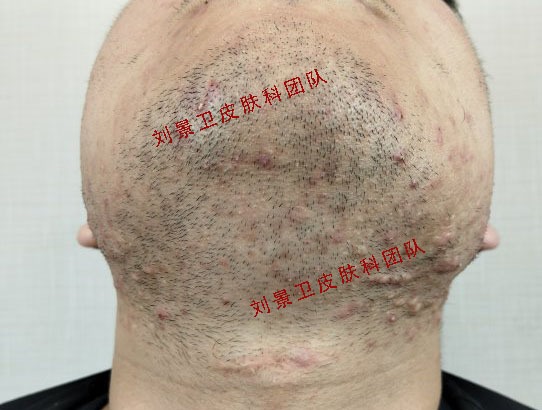 痤疮 (2).jpg