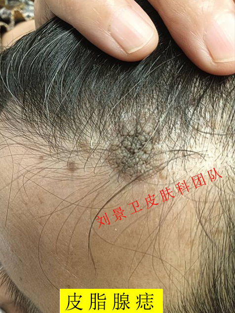皮脂腺痣.jpg