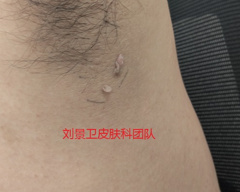 丝状疣 (2).jpg