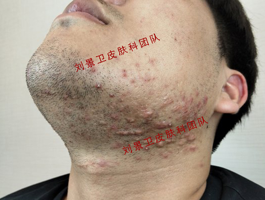 痤疮 (4).jpg