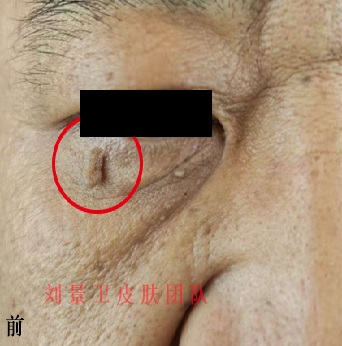 丝状疣.jpg