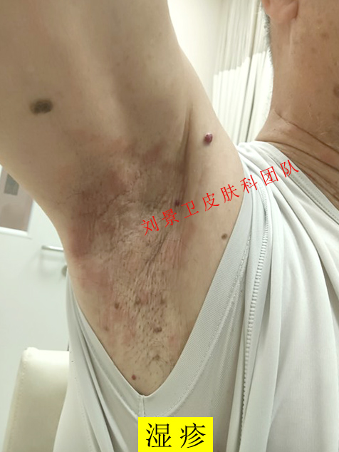 湿疹.jpg