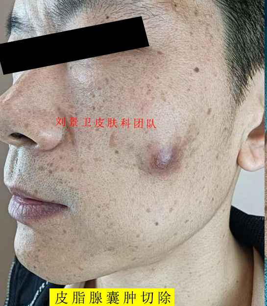皮脂腺囊肿2.jpg
