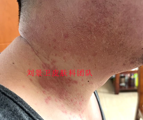 慢性荨麻疹10月21日 1555理部.jpg