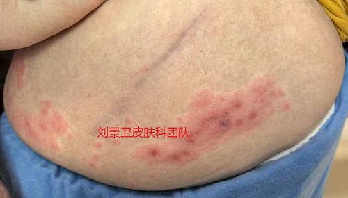 带状疱疹 (2).jpg