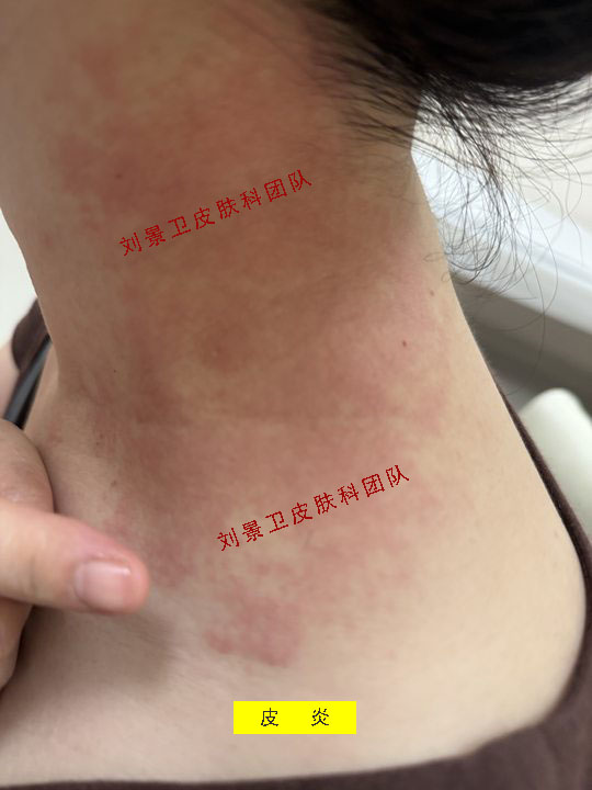皮炎.jpg