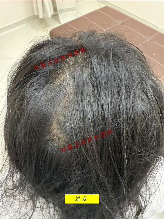 女性脱发.jpg