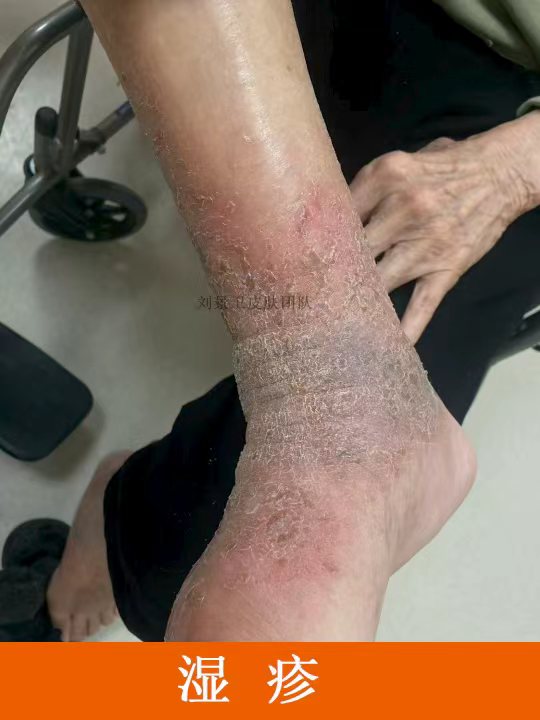 湿疹 (2).jpg