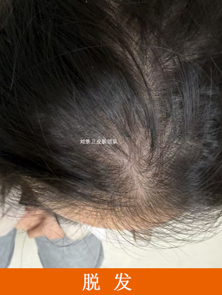 脱发 (3).jpg