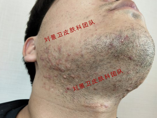 痤疮 (3).jpg