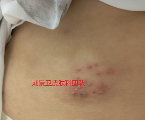 带状疱疹.jpg