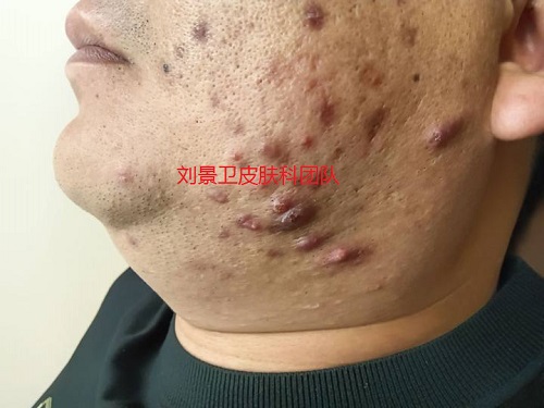 痤疮疤痕.jpg